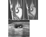 cyst parasit